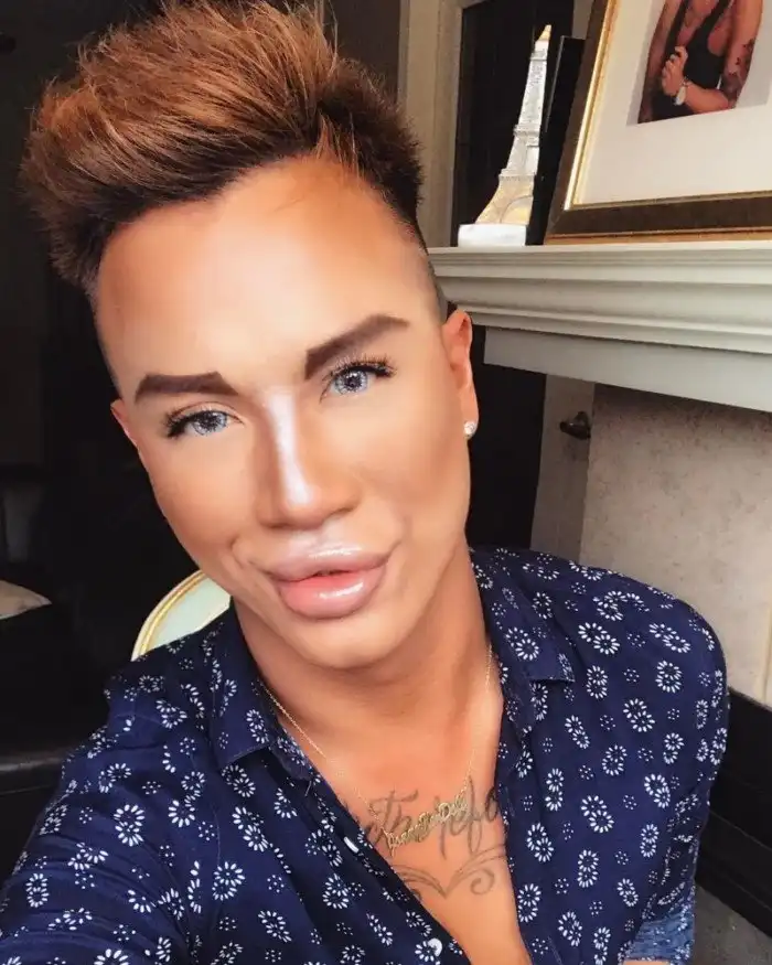 У канадца, увлеченного пластикой, не закрывается рот из-за инъекций филлеров