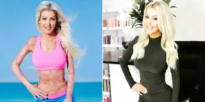 Её подожгла ревнивая жена и 200 операций лишь немного сгладили ужас произошедшего