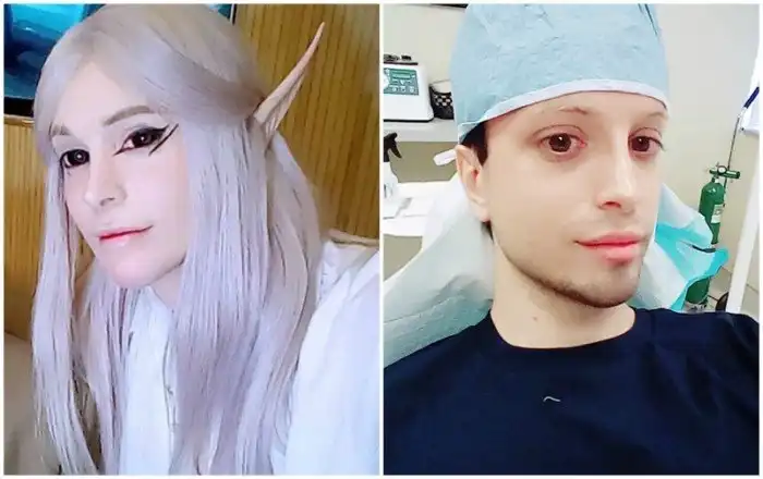 "Живой эльф" потратил $12 тысяч на операцию по пересадке волос