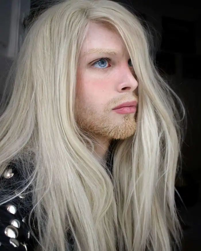 "Живой эльф" потратил $12 тысяч на операцию по пересадке волос