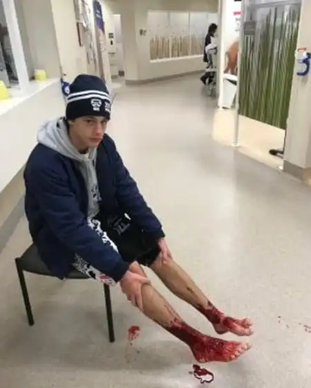 Неизвестные существа искусали ноги австралийского подростка