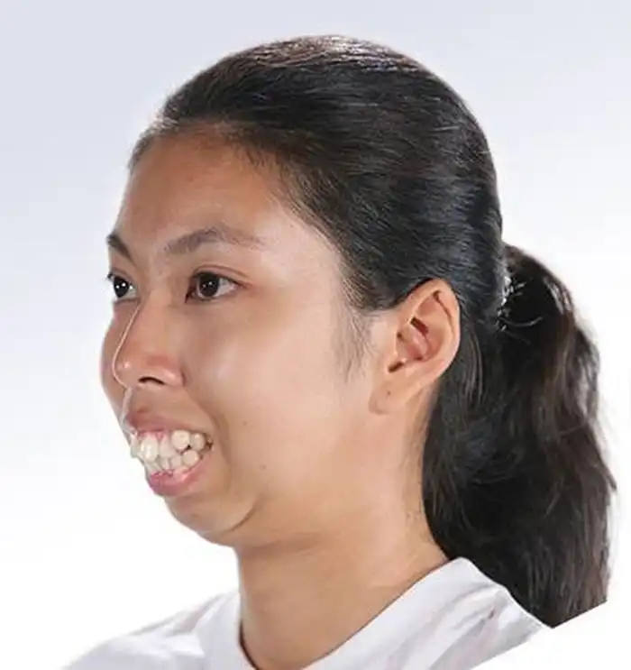 Девушка с деформацией челюсти решила поучаствовать в шоу талантов и теперь её не узнать