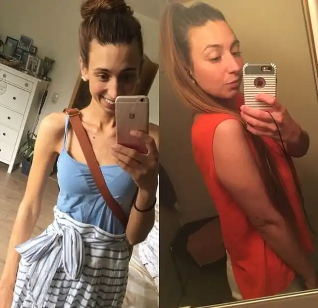 Девушка поборола анорексию