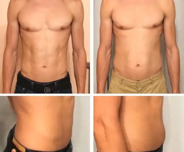 Парень поставил эксперимент и выпивал литр пива ежедневно