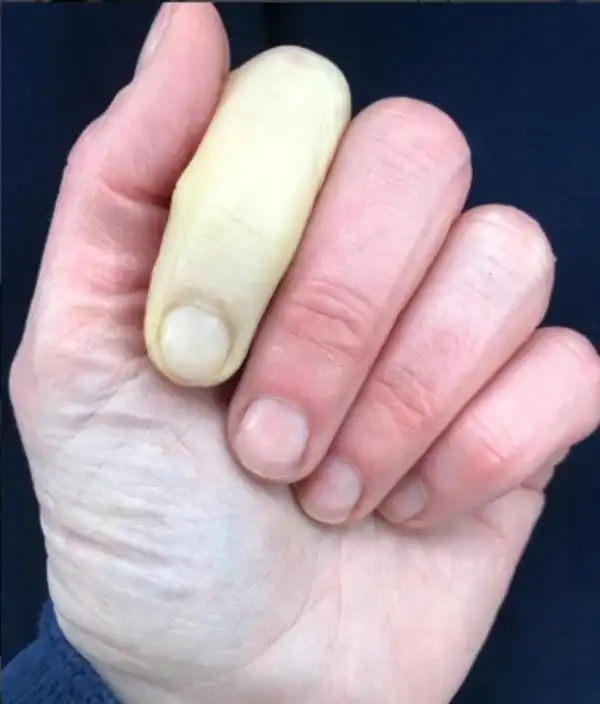 Британская телеведущая Дженни Фалконер показала последствия редкого заболевания