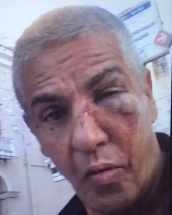 Фотография Сами Насери после драки в караоке-баре в Москве