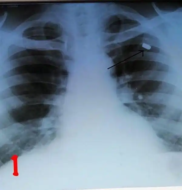 Врачи извлекли пулю из груди россиянина, с которой он прожил 30 лет