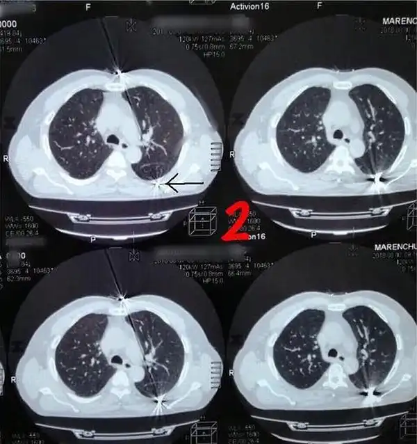 Врачи извлекли пулю из груди россиянина, с которой он прожил 30 лет