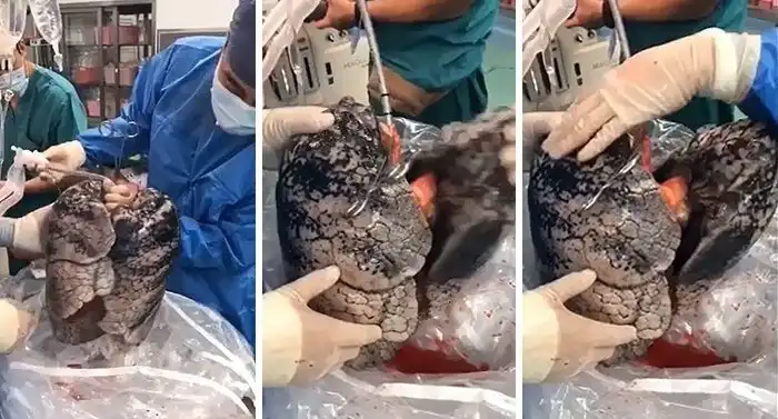 Хирурги показали, как выглядят легкие человека после 30 лет курения