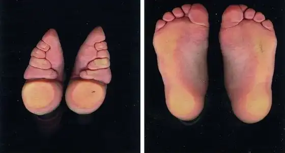 Ноги-лотосы: зачем китайские девушки уродовали свои ступни?