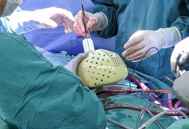 В США впервые в истории имплантировали человеку полностью искусственное сердце