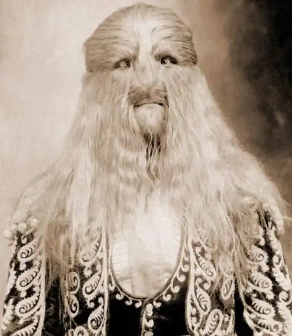 Удивительная история “мальчика-льва” Стефана Бибровского