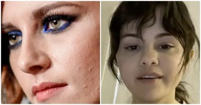 Мешки под глазами и прыщи: как на самом деле выглядит кожа знаменитостей без обработки