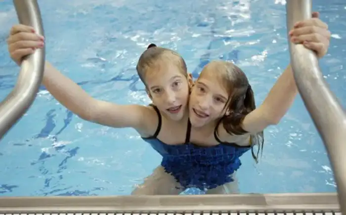 Как две сестры уже больше 30 лет живут в одном теле