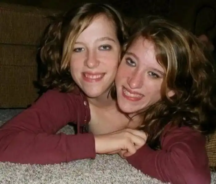 Как две сестры уже больше 30 лет живут в одном теле