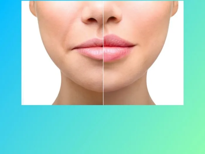 Все, что вы не знали об увеличении губ!