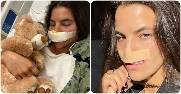 Встреча с питбулем навсегда изменила жизнь девушки, лишив её верхней губы