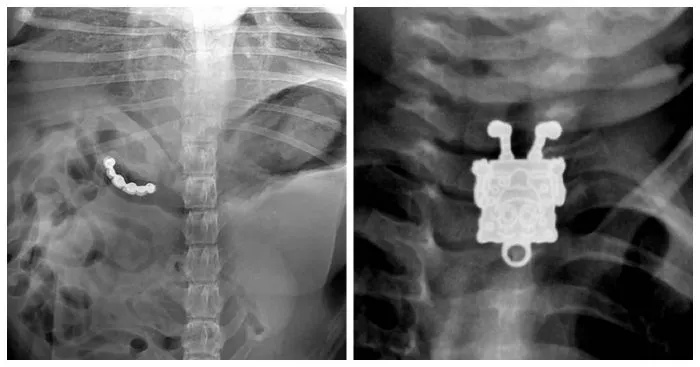 У них это было в теле: 17 удивительных рентгеновских снимков