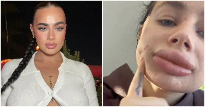 Девушка увеличила губы и пожалела об этом - своим неудачным опытом она поделилась в соцсетях