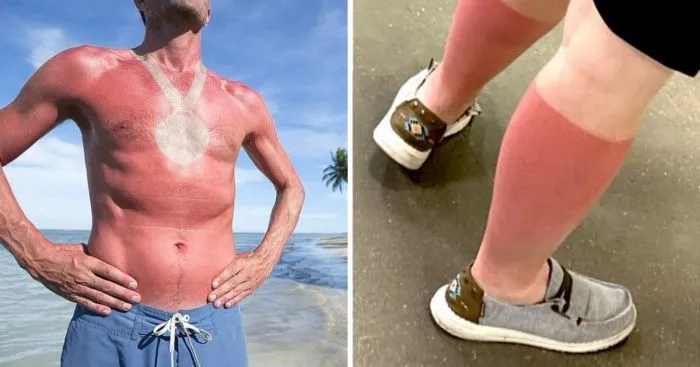 17 случаев, когда люди недооценили обжигающую силу солнца