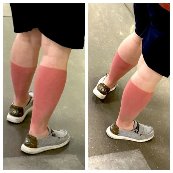 17 случаев, когда люди недооценили обжигающую силу солнца