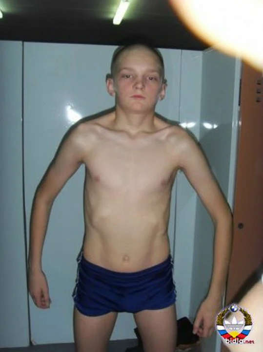 Синдром широкой спины⁠⁠