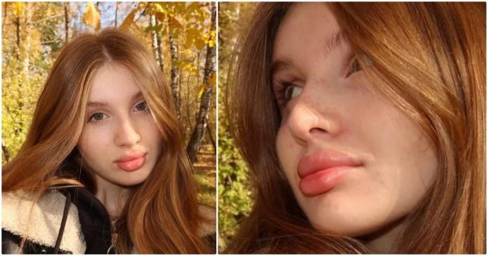 «Увеличиваю губы с 16 лет, но зависимости нет», — девушка о своих изменениях