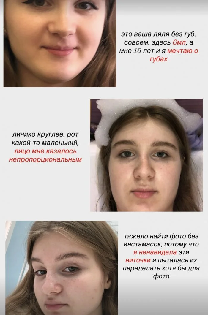 «Увеличиваю губы с 16 лет, но зависимости нет», — девушка о своих изменениях