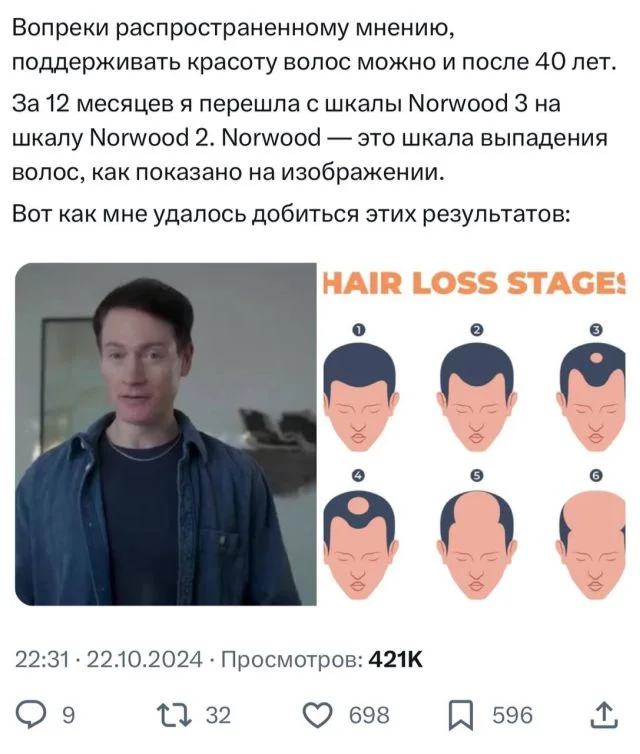 Молодой человек поделился секретом, как восстановил густые волосы и победил облысение