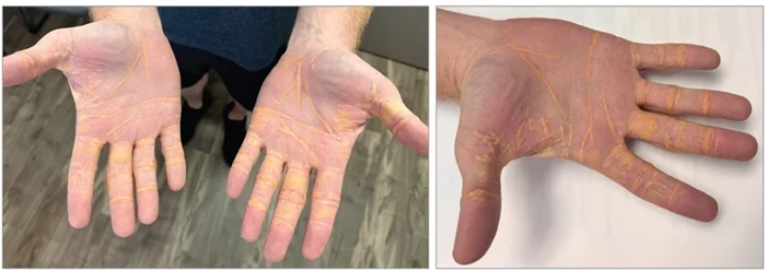 Диета из масла, сыра и мяса: когда холестерин зашкаливает