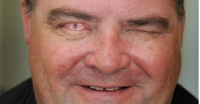 Зуб в глазу: зачем врачи пересаживают зуб для восстановления зрения?