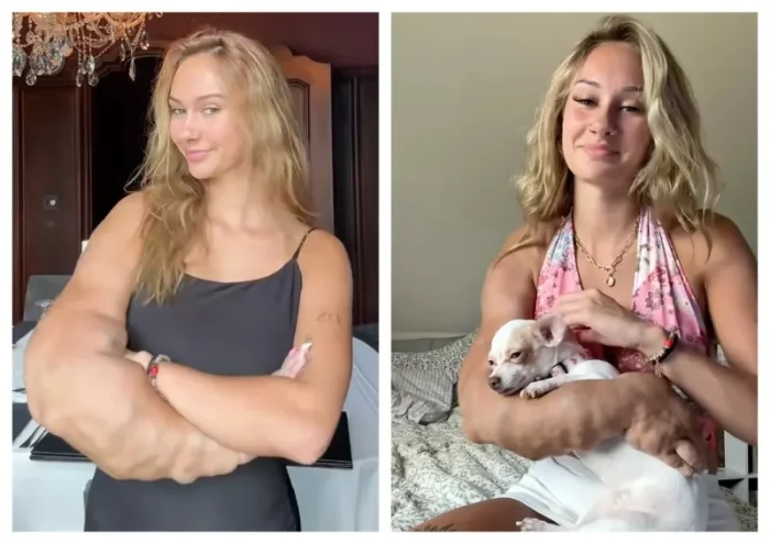 Из-за сосудистой аномалии рука начала стремительно расти