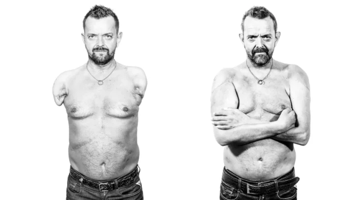 Человек-пазл: как исландец обрёл органы от доноров из разных стран