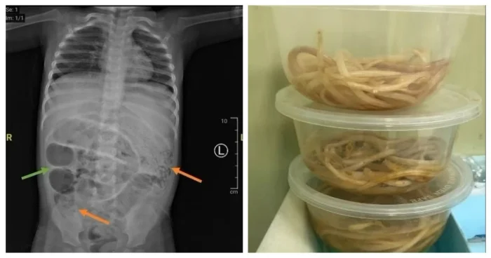 Почему не стоит пить сырую воду: кадры удаления огромных паразитов из тела